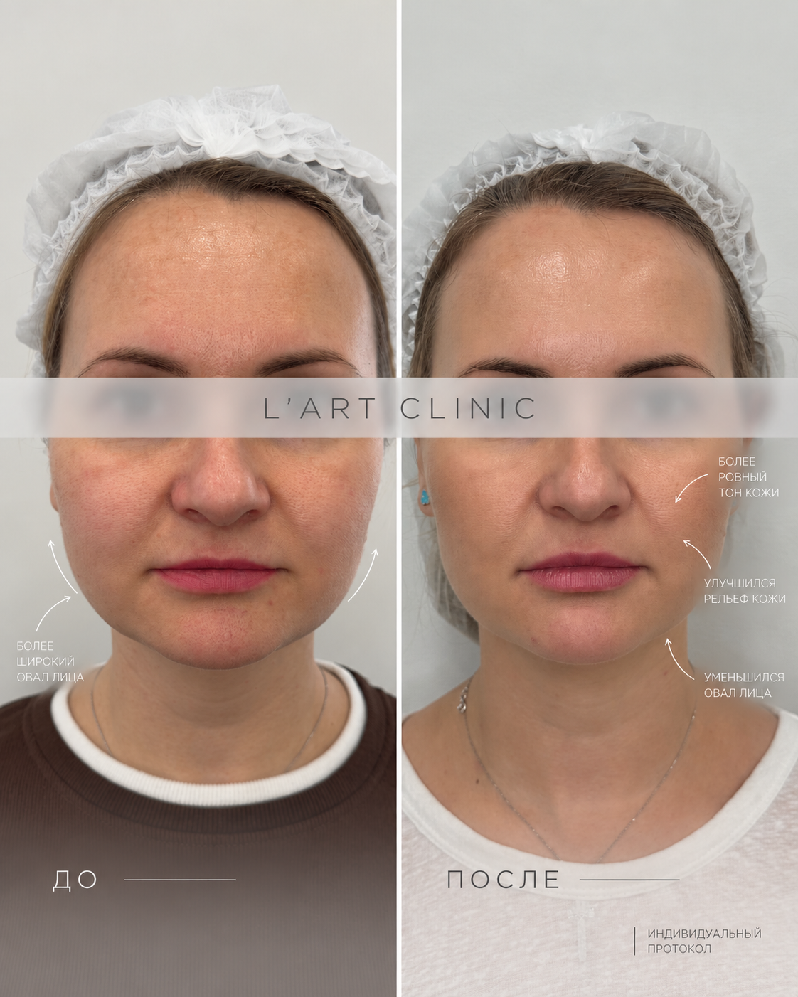 Ультраформер/SMAS-lifting ULTRAFORMER -50%