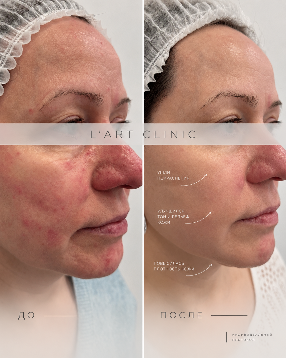 Пилинг Peach Peel в подарок к SkinTyte!